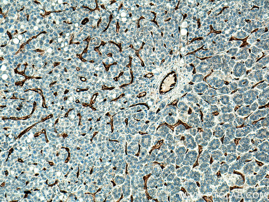 IHC staining of human liver cancer using 11265-1-AP