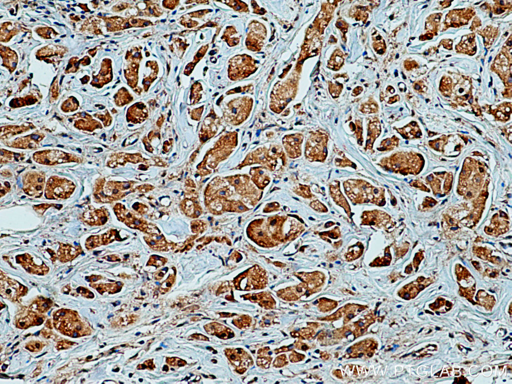 IHC staining of human breast cancer using 67202-1-Ig