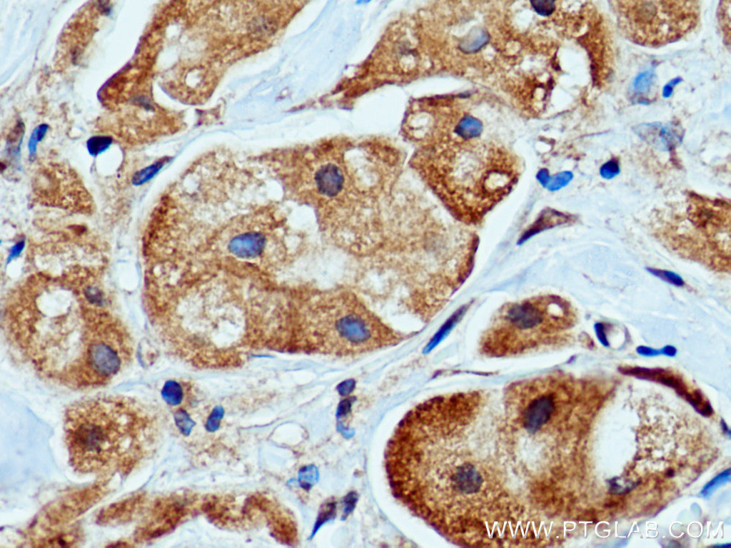 IHC staining of human breast cancer using 67202-1-Ig