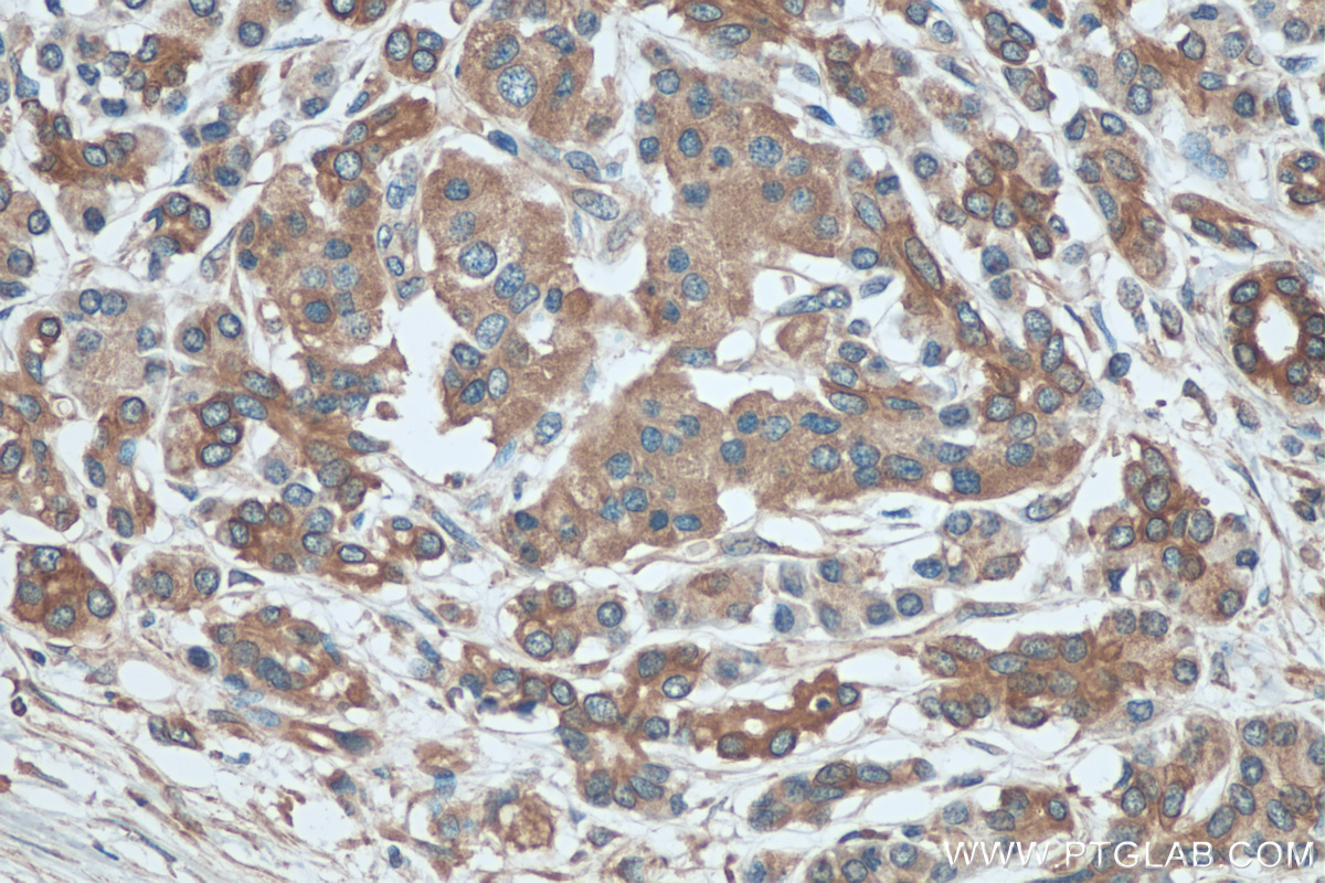 IHC staining of human pancreas cancer using 20582-1-AP