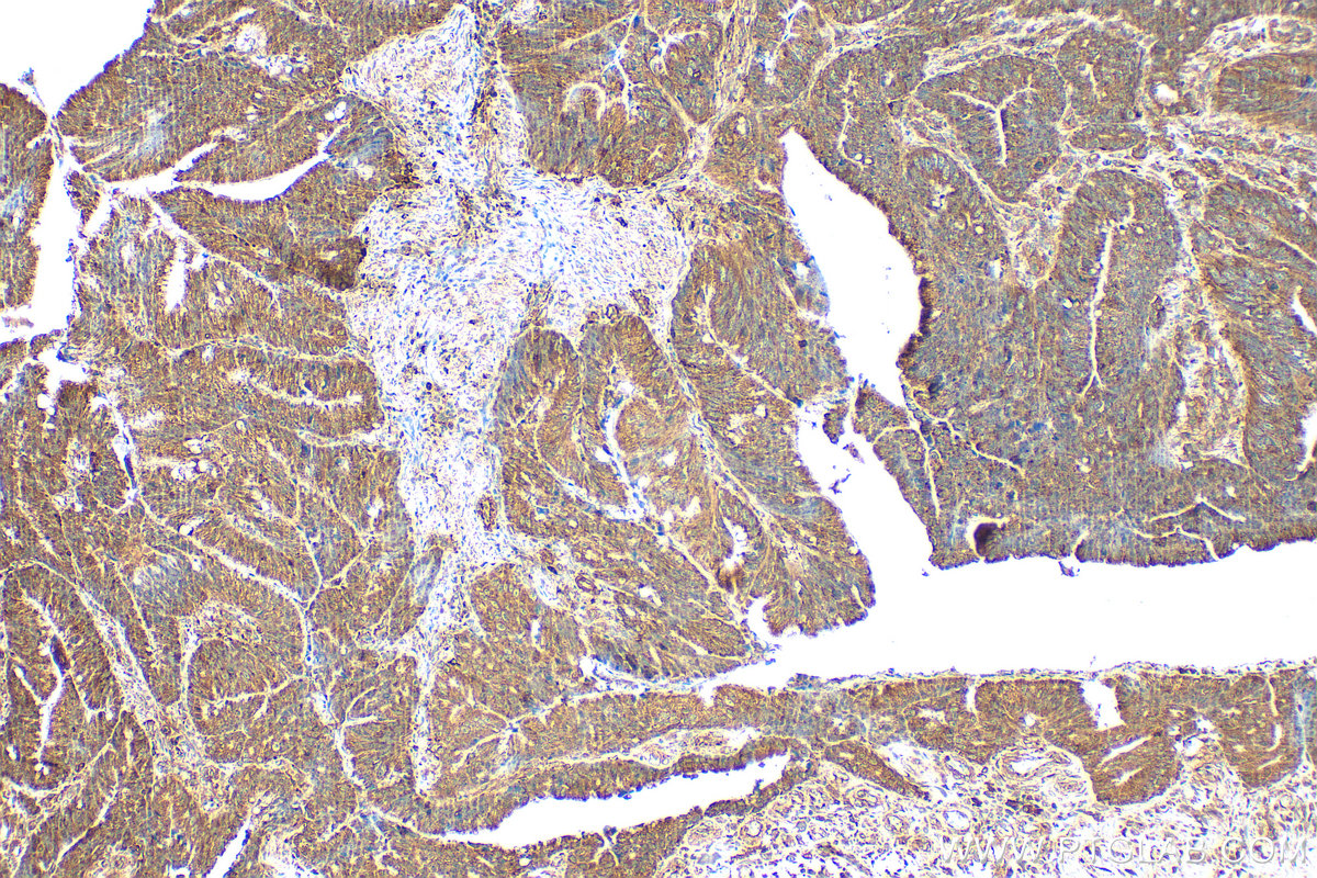 IHC staining of human colon cancer using 31322-1-AP IHC staining of human colon cancer using 31322-1-AP