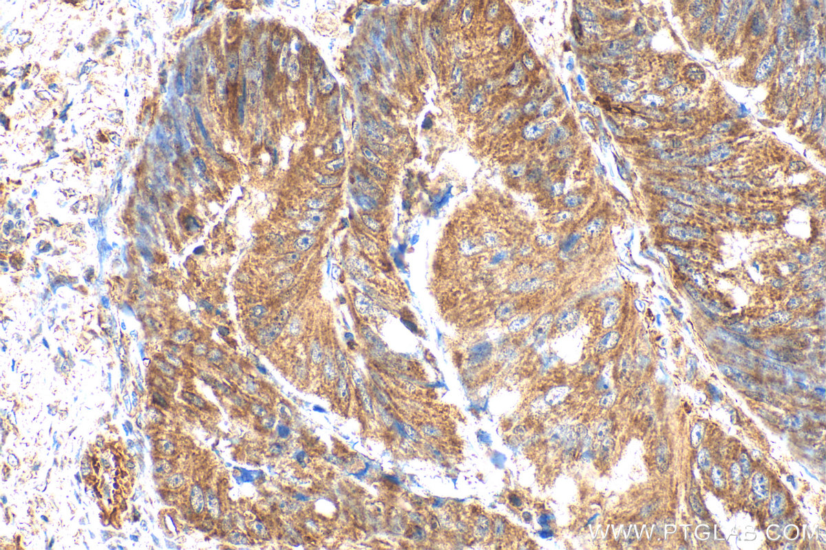 IHC staining of human colon cancer using 31322-1-AP IHC staining of human colon cancer using 31322-1-AP