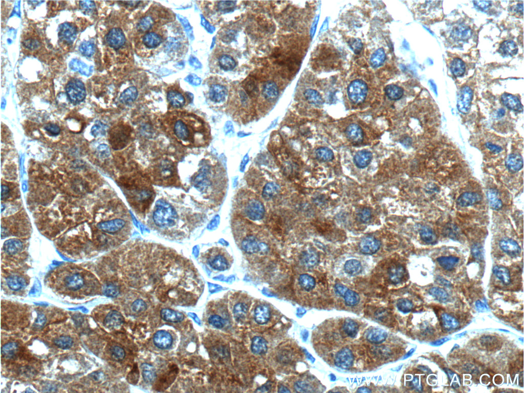 IHC staining of human liver cancer using 13669-1-AP