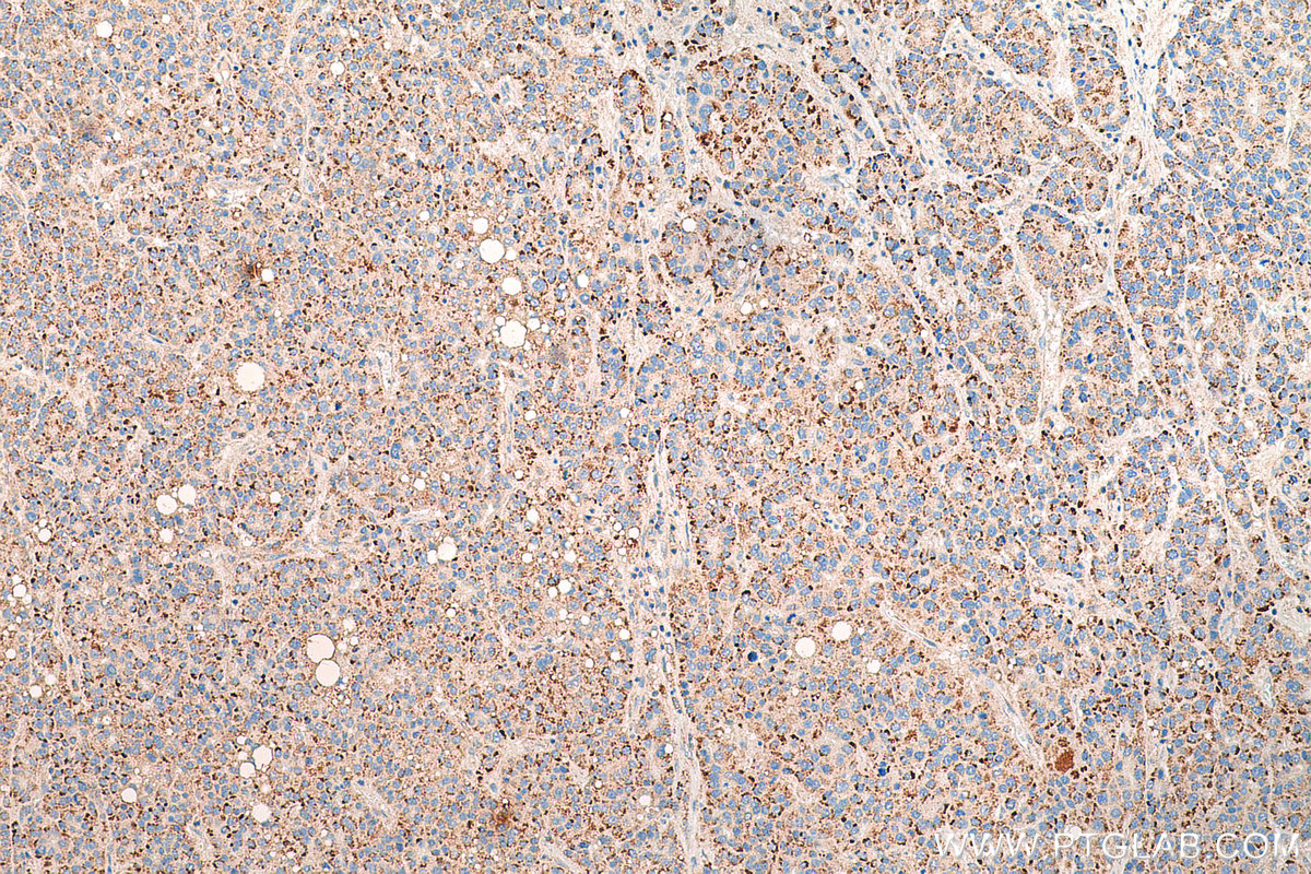 IHC staining of human liver cancer using 80234-1-RR (same clone as 80234-1-PBS)