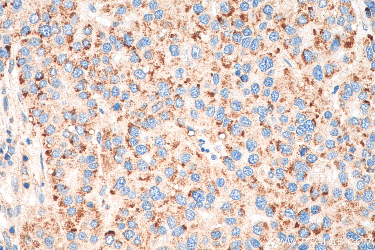 IHC staining of human liver cancer using 80234-1-RR (same clone as 80234-1-PBS)