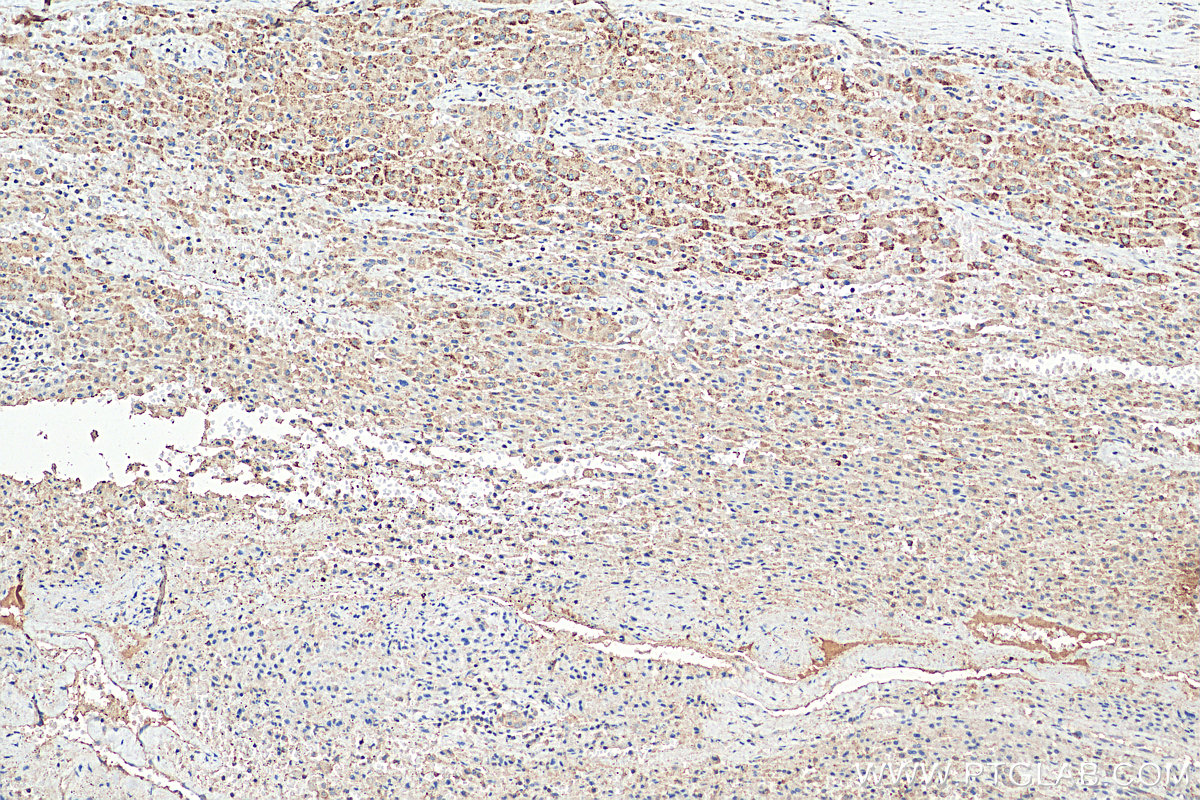 IHC staining of human liver cancer using 80196-1-RR (same clone as 80196-1-PBS)