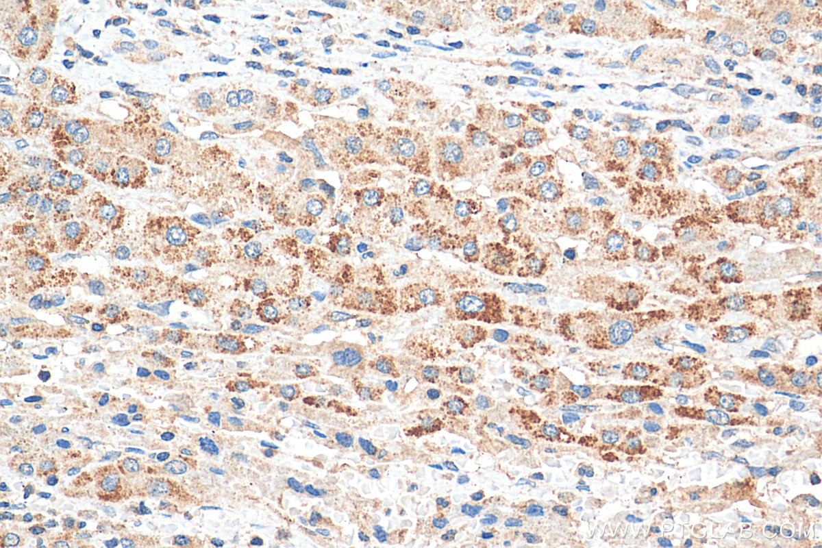 IHC staining of human liver cancer using 80196-1-RR (same clone as 80196-1-PBS)