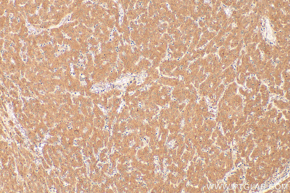IHC staining of human liver cancer using 68555-1-Ig IHC staining of human liver cancer using 68555-1-Ig
