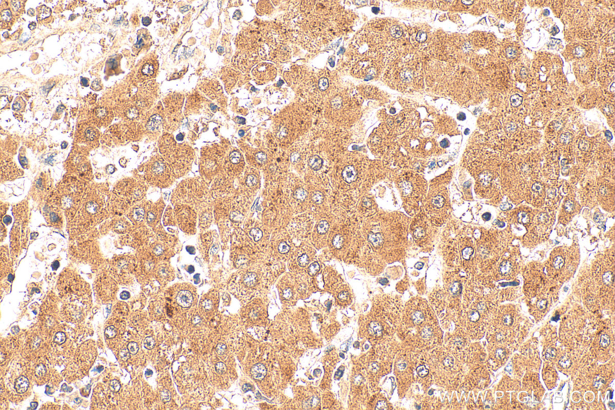 IHC staining of human liver cancer using 68555-1-Ig IHC staining of human liver cancer using 68555-1-Ig