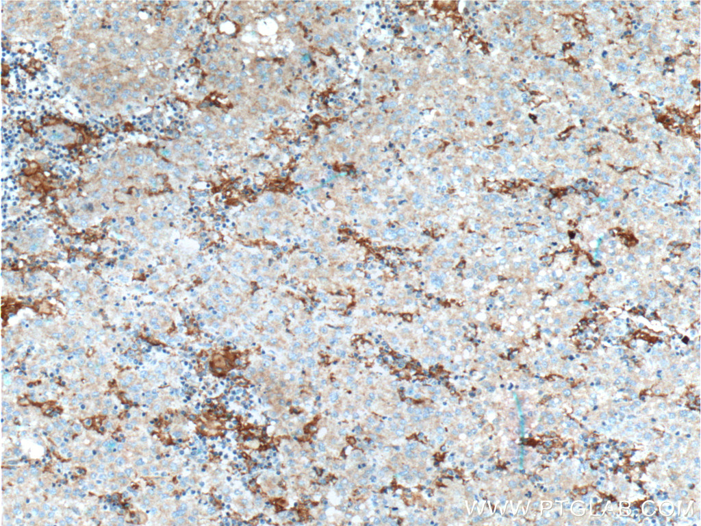 IHC staining of human liver cancer using 21718-1-AP