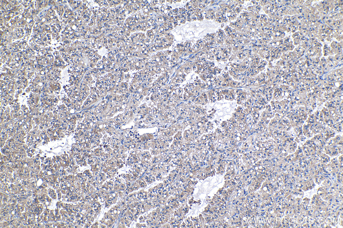 IHC staining of human lung cancer using 68385-1-Ig (same clone as 68385-1-PBS)