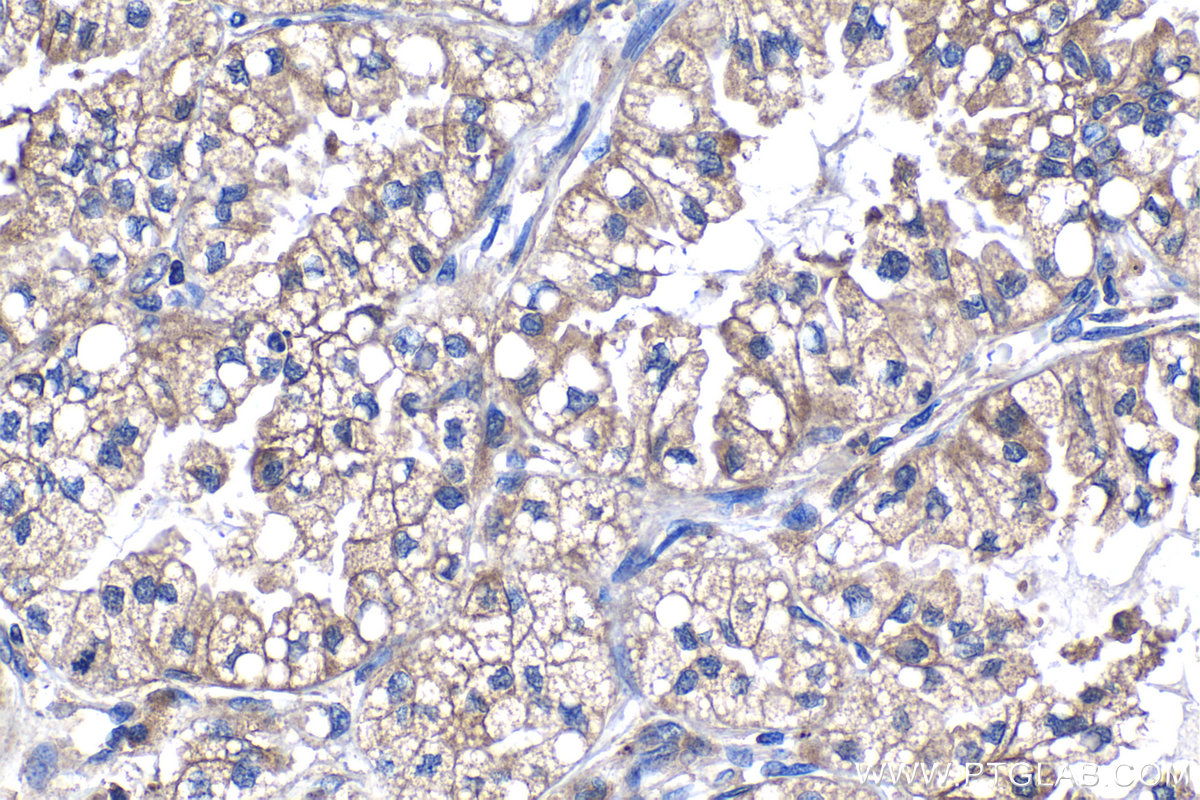 IHC staining of human lung cancer using 68385-1-Ig