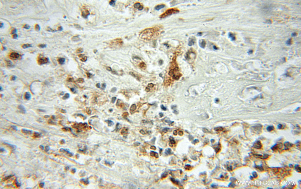 Profilin 1