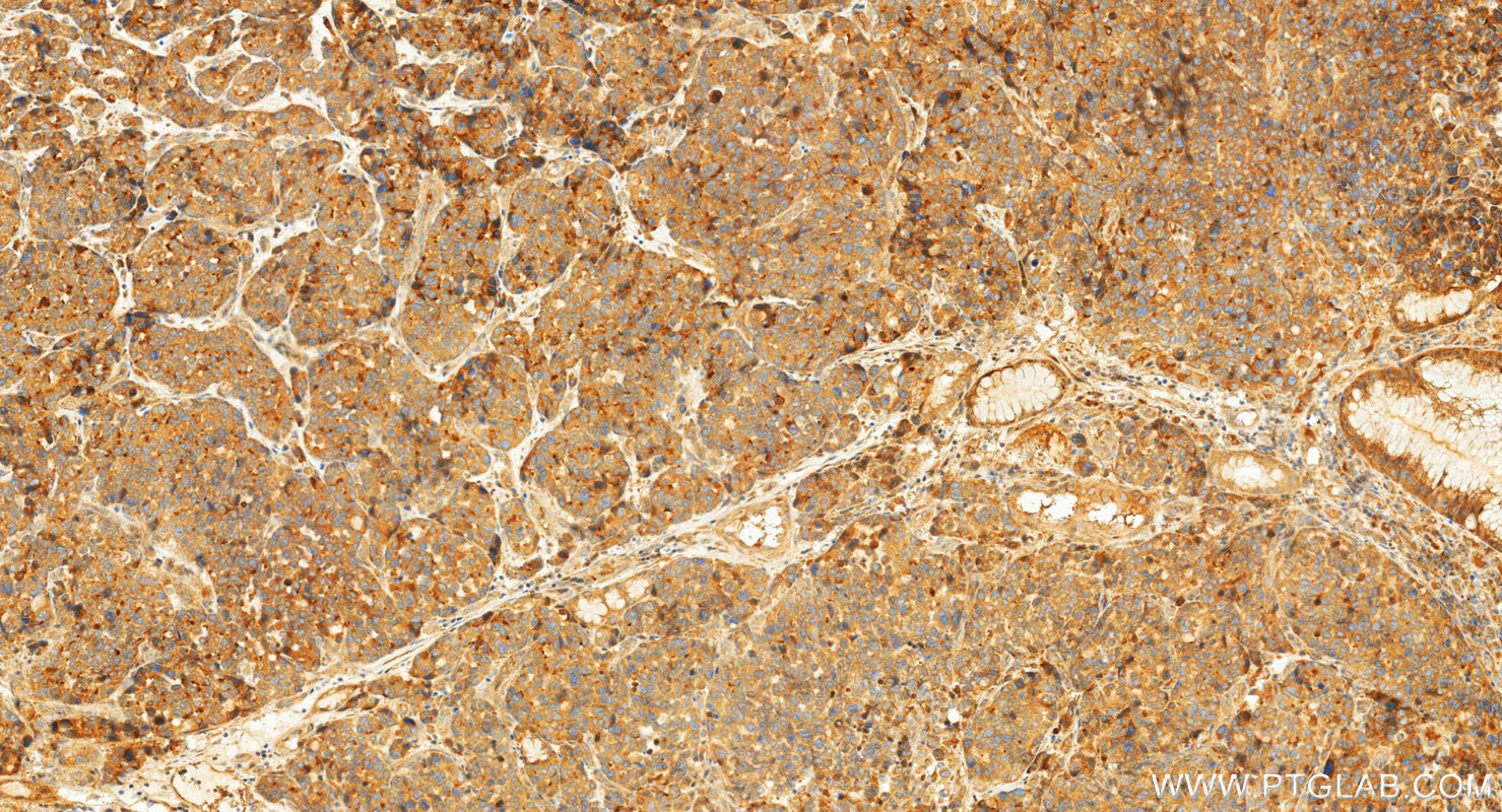 IHC staining of human stomach cancer using 33764-1-AP (same clone as 33764-1-PBS) IHC staining of human stomach cancer using 33764-1-AP (same clone as 33764-1-PBS)