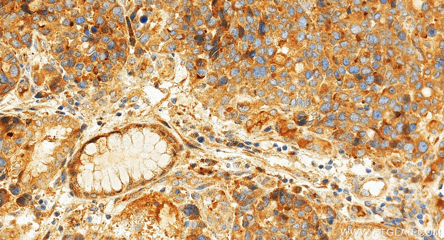 IHC staining of human stomach cancer using 33764-1-AP (same clone as 33764-1-PBS) IHC staining of human stomach cancer using 33764-1-AP (same clone as 33764-1-PBS)