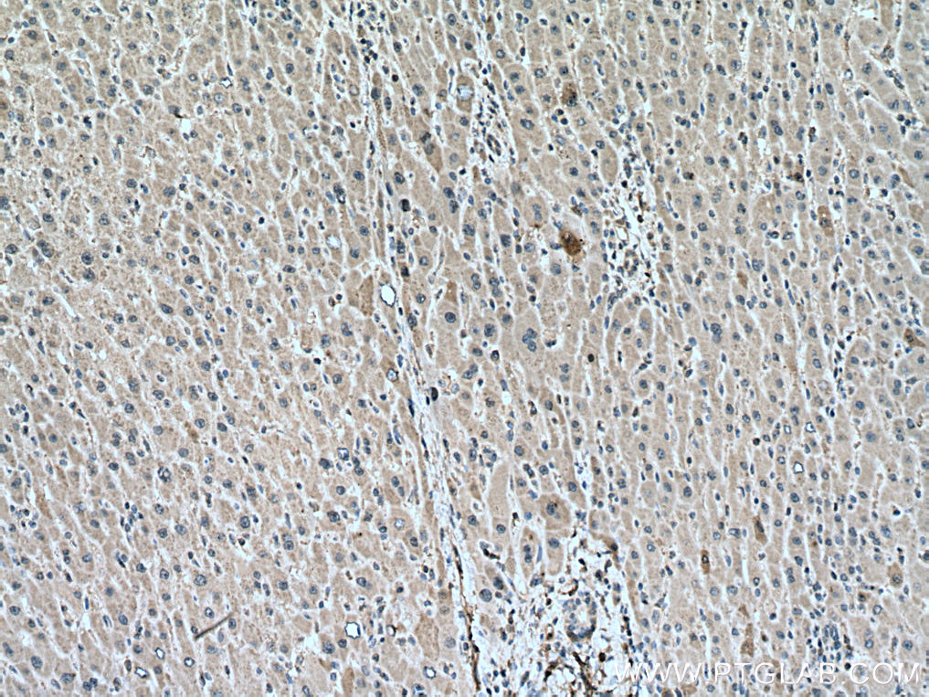 IHC staining of human liver cancer using 67470-1-Ig (same clone as 67470-1-PBS)