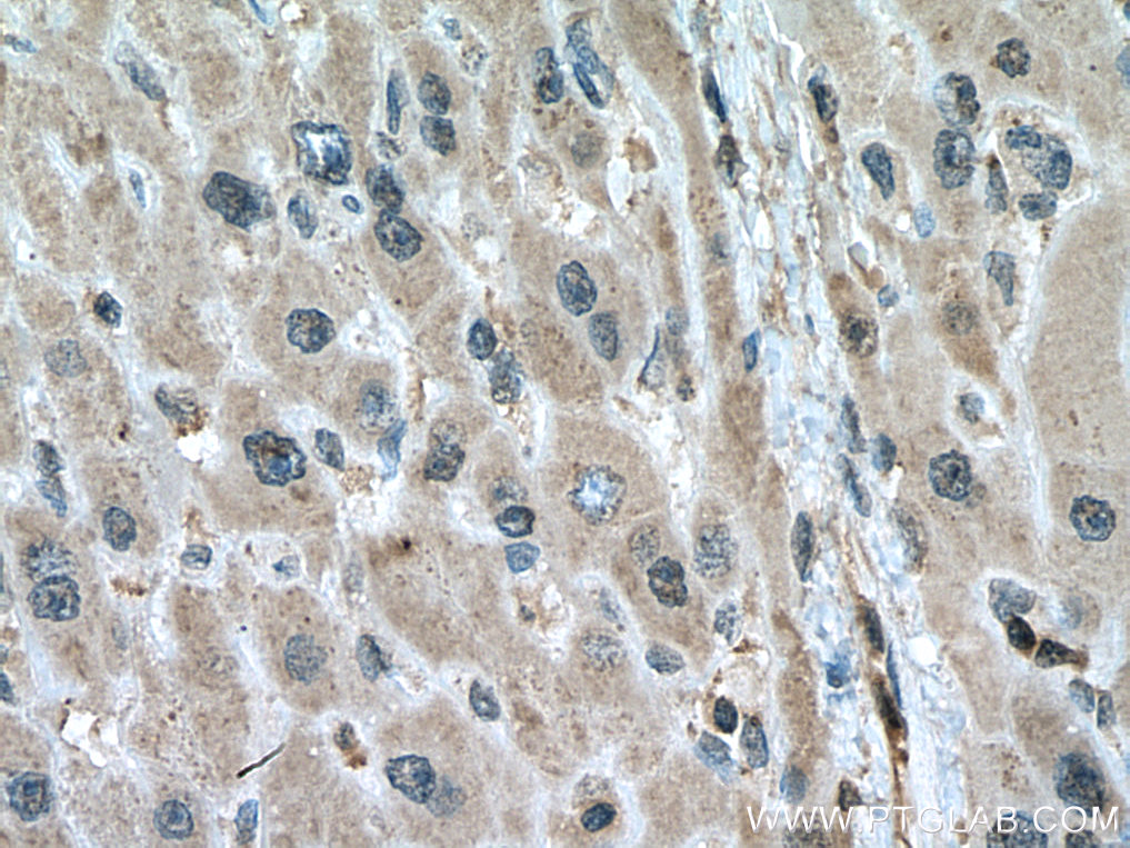 IHC staining of human liver cancer using 67470-1-Ig (same clone as 67470-1-PBS)