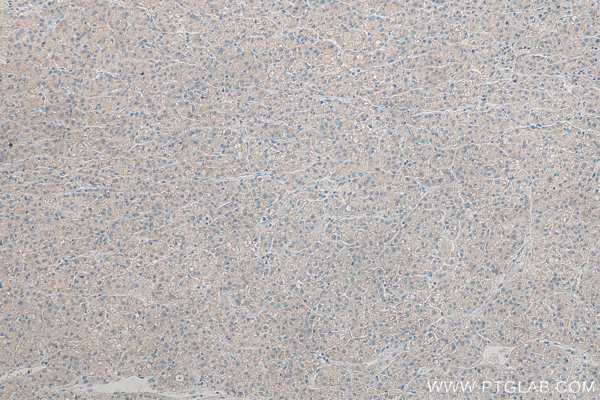 IHC staining of human liver cancer using 68116-1-Ig (same clone as 68116-1-PBS)