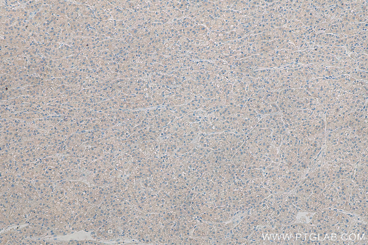 IHC staining of human liver cancer using 68116-1-Ig