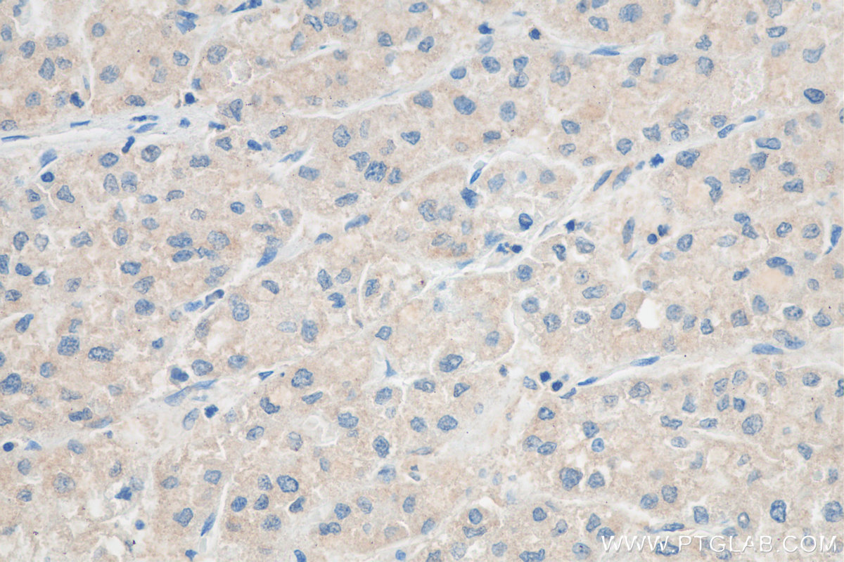 IHC staining of human liver cancer using 68116-1-Ig