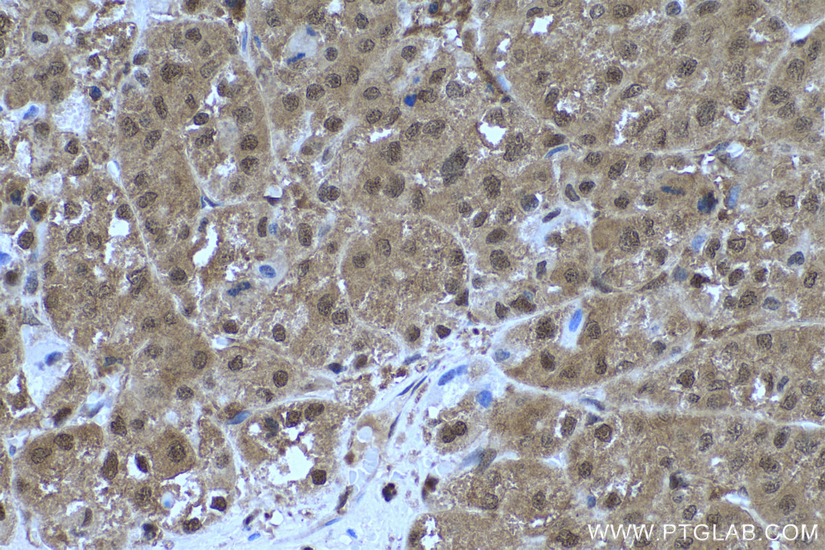 IHC staining of human liver cancer using 68035-1-Ig