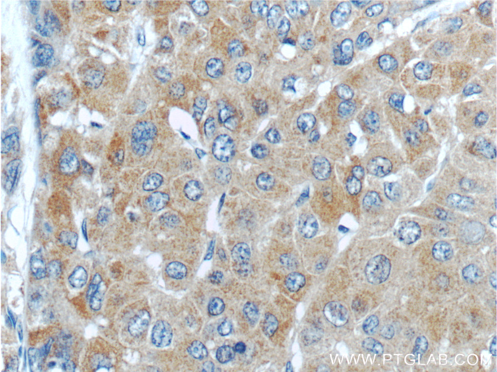 IHC staining of human liver cancer using 23029-1-AP