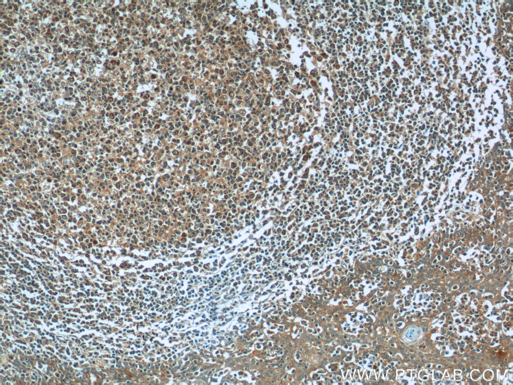 IHC staining of human tonsillitis using 25081-1-AP