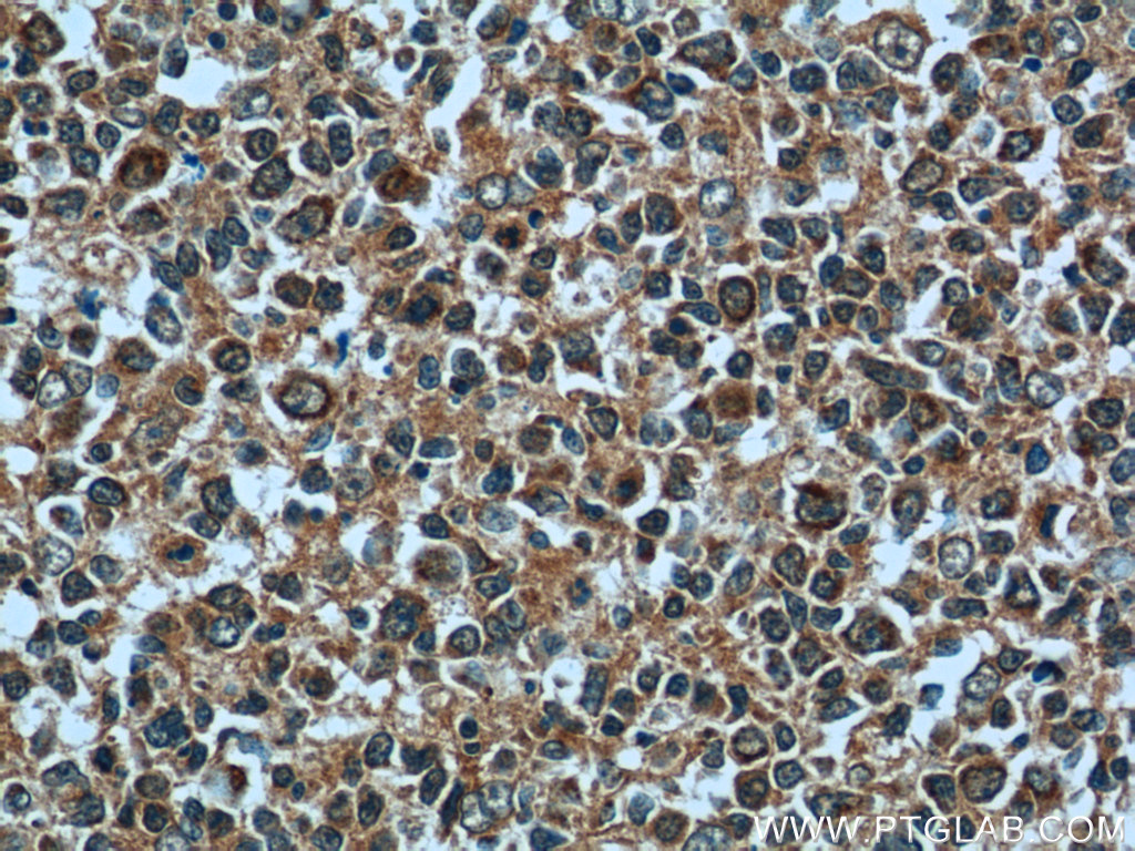 IHC staining of human tonsillitis using 25081-1-AP