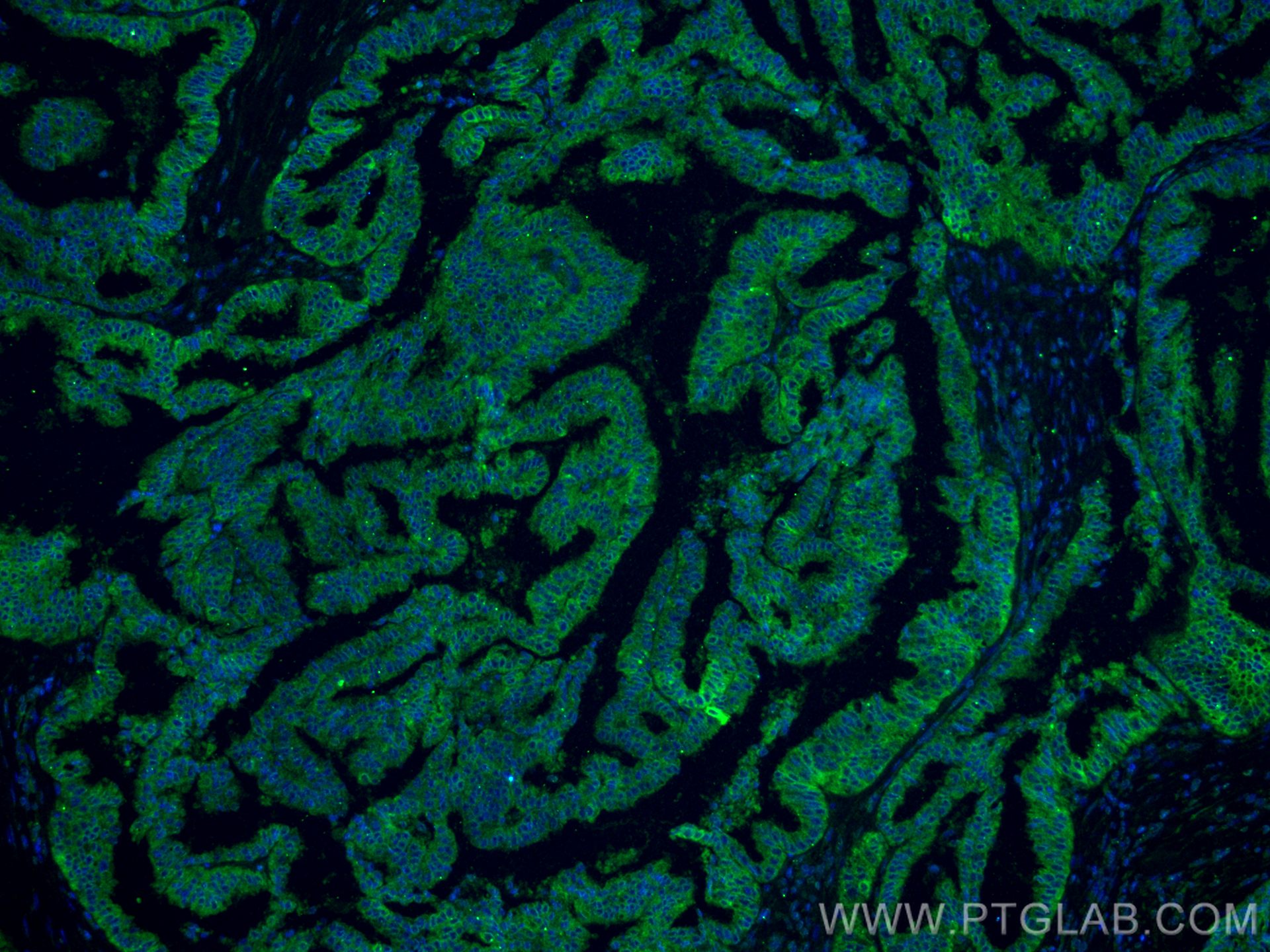IF Staining of human ovary tumor using 66372-1-Ig