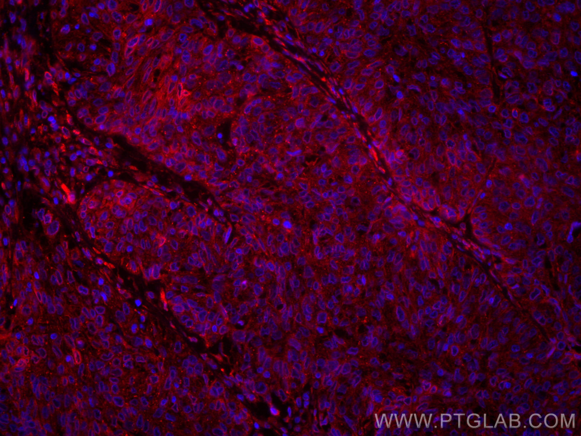 IF Staining of human cervical cancer using CL594-60249