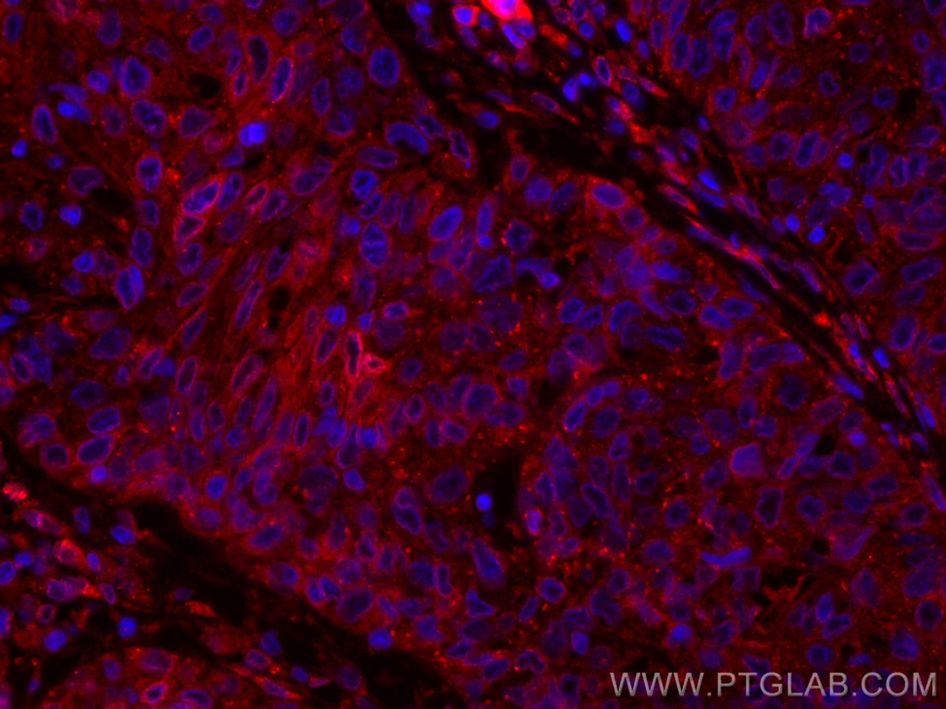 IF Staining of human cervical cancer using CL594-60249