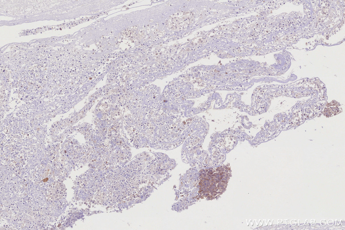 IHC staining of human ovary cancer using 83302-1-RR IHC staining of human ovary cancer using 83302-1-RR