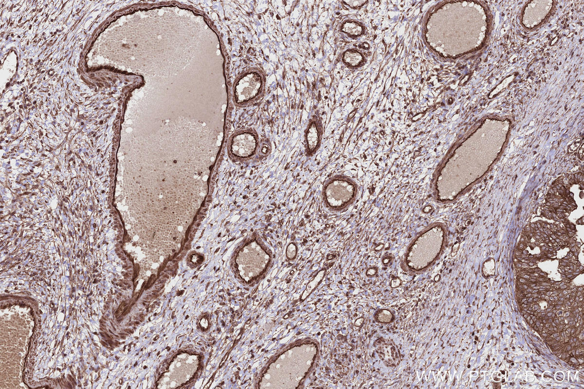 IHC staining of human ovary cancer using 13408-1-AP IHC staining of human ovary cancer using 13408-1-AP
