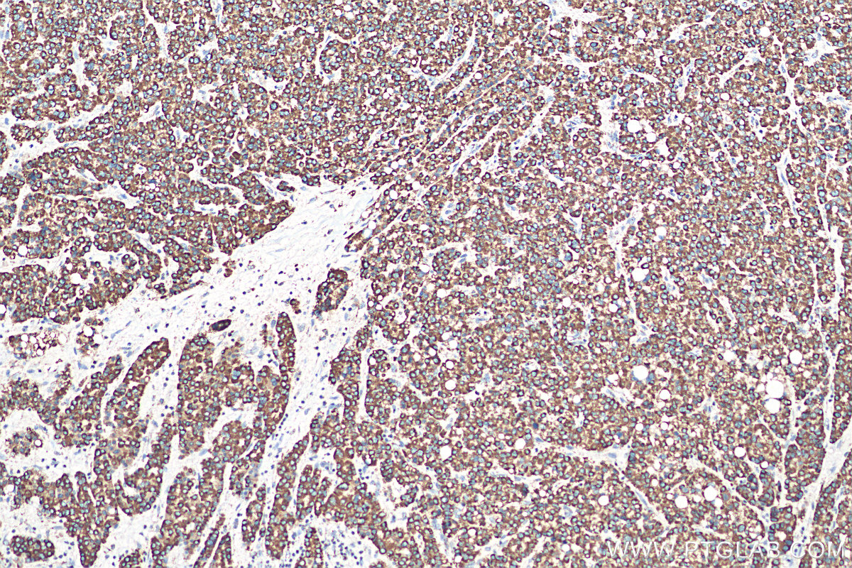 IHC staining of human liver cancer using 10787-1-AP