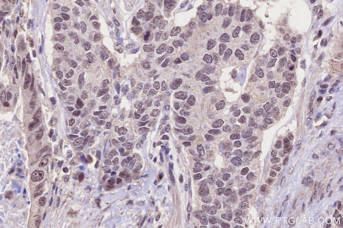 IHC staining of human stomach cancer using 51062-1-AP