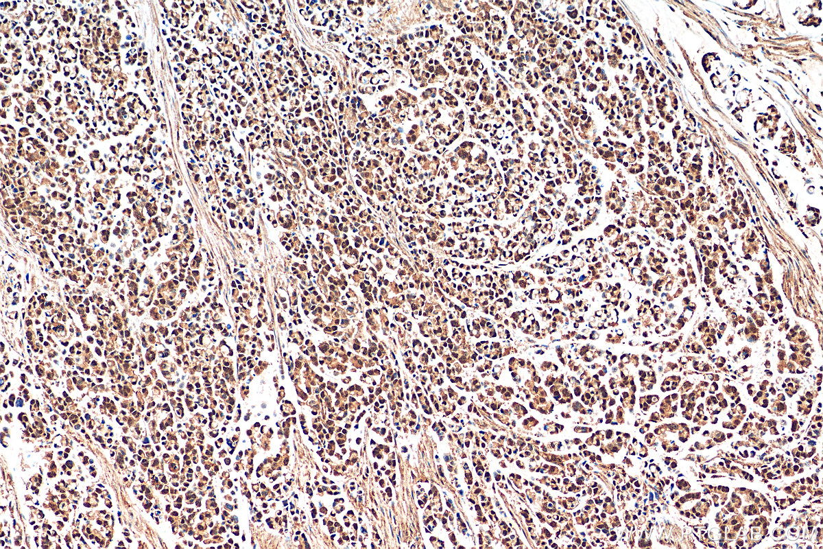 IHC staining of human colon cancer using 29516-1-AP