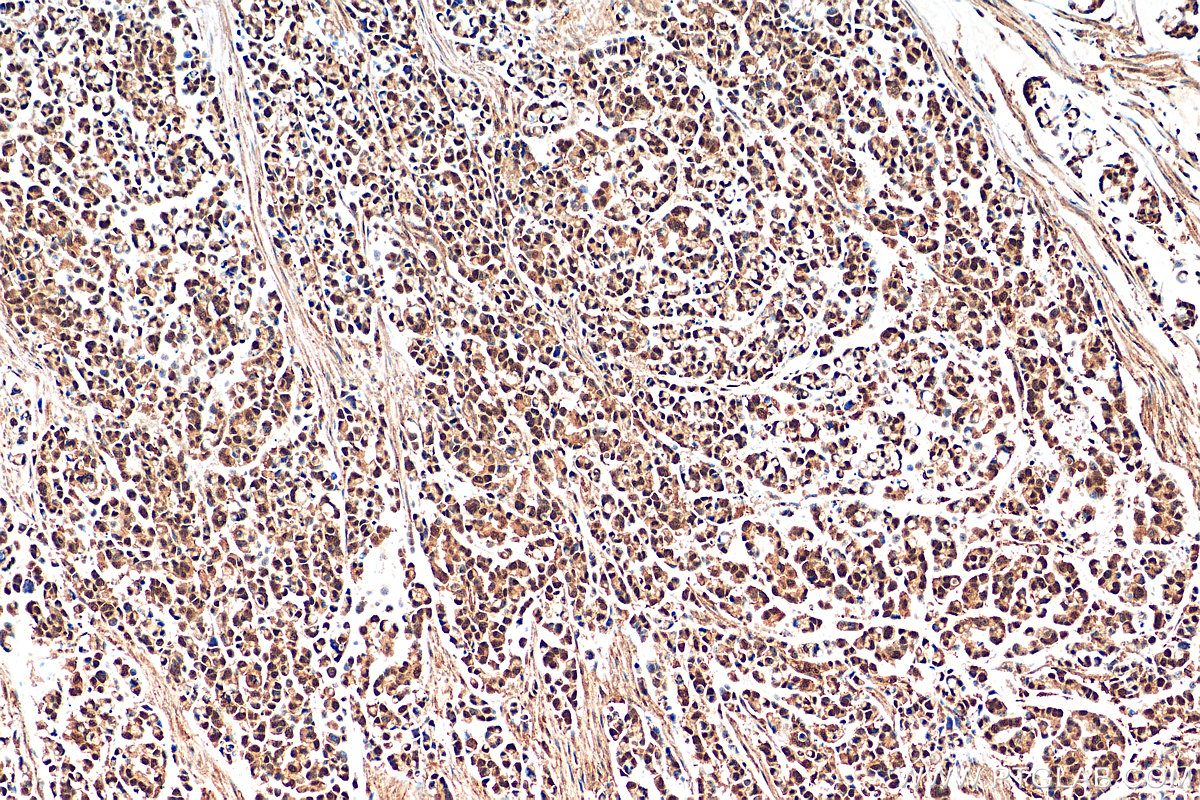 IHC staining of human colon cancer using 29516-1-AP (same clone as 29516-1-PBS)