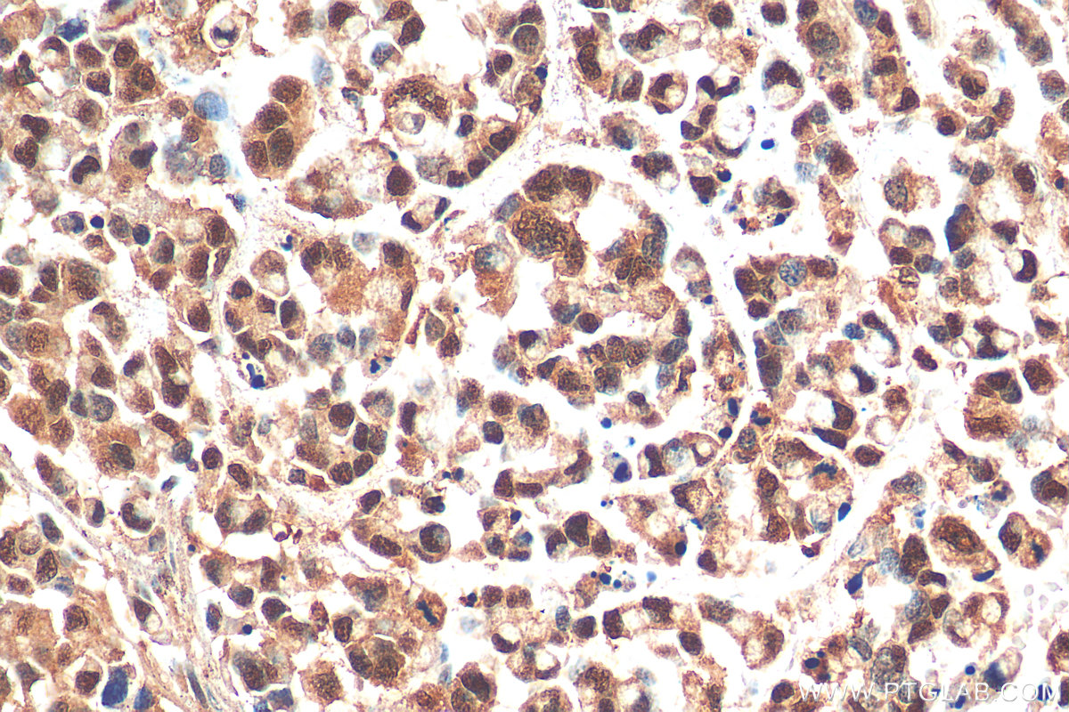 IHC staining of human colon cancer using 29516-1-AP (same clone as 29516-1-PBS)