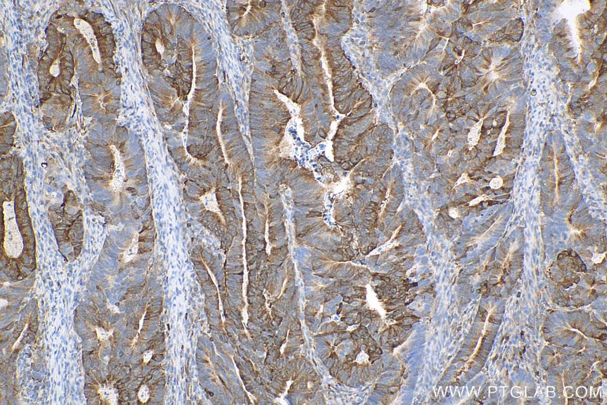 IHC staining of human colon cancer using 81986-1-RR (same clone as 81986-1-PBS)