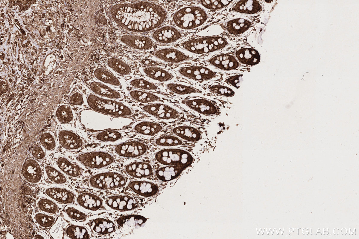 IHC staining of human rectal cancer using 13400-1-AP IHC staining of human rectal cancer using 13400-1-AP