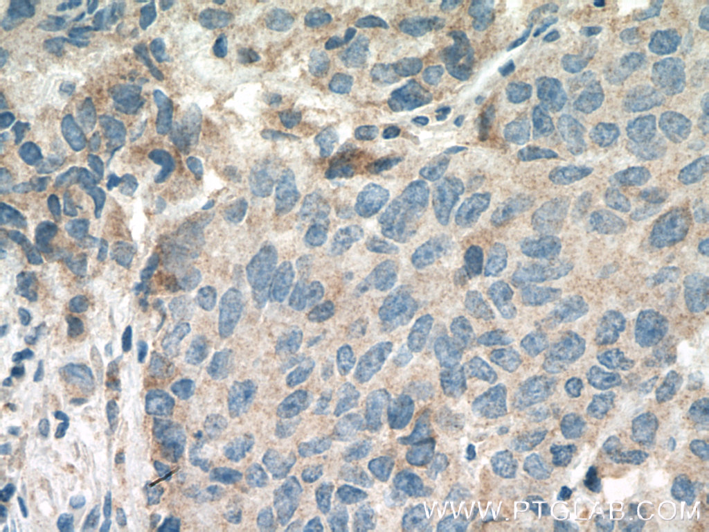 IHC staining of human prostate cancer using 14661-1-AP