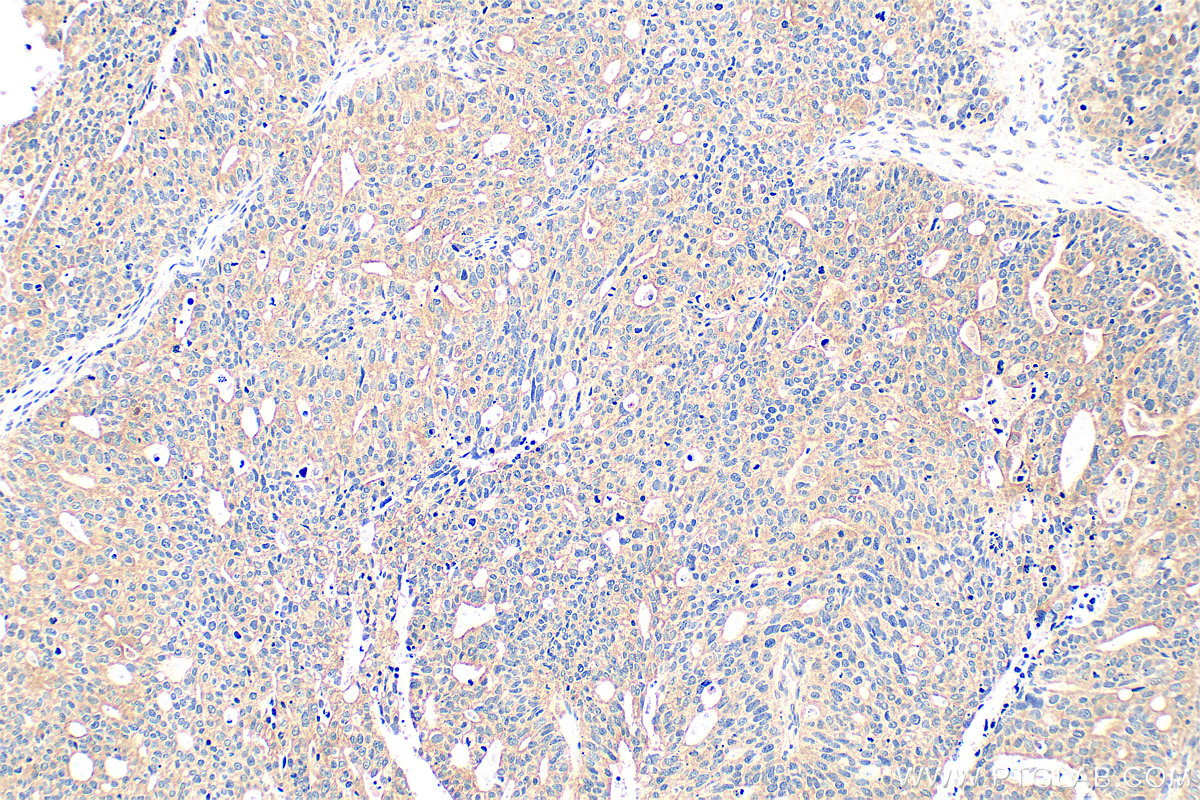 IHC staining of human ovary tumor using 33225-1-AP (same clone as 33225-1-PBS)