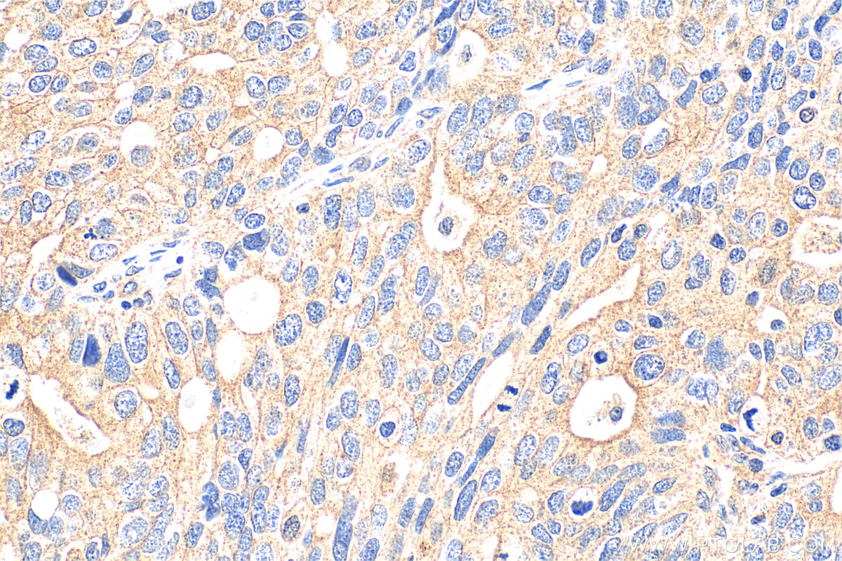 IHC staining of human ovary tumor using 33225-1-AP (same clone as 33225-1-PBS)