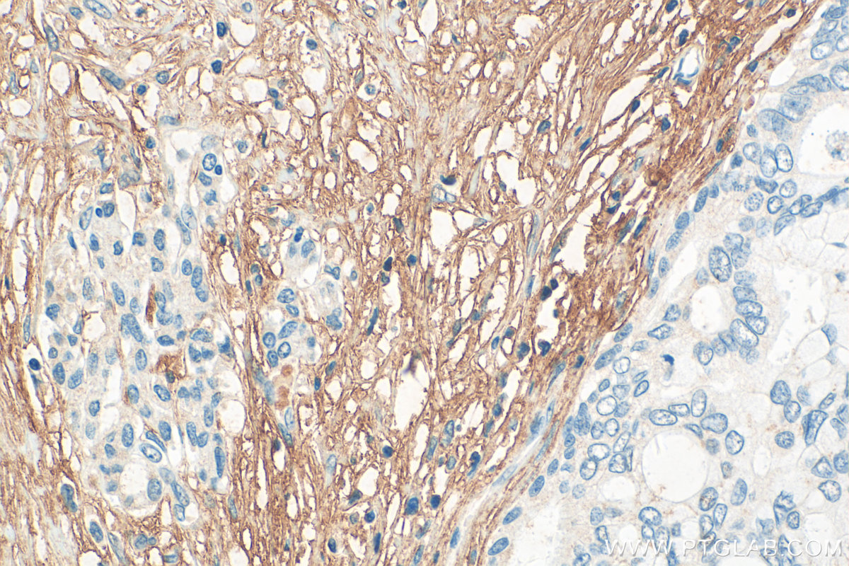 IHC staining of human pancreas cancer using 12267-1-AP