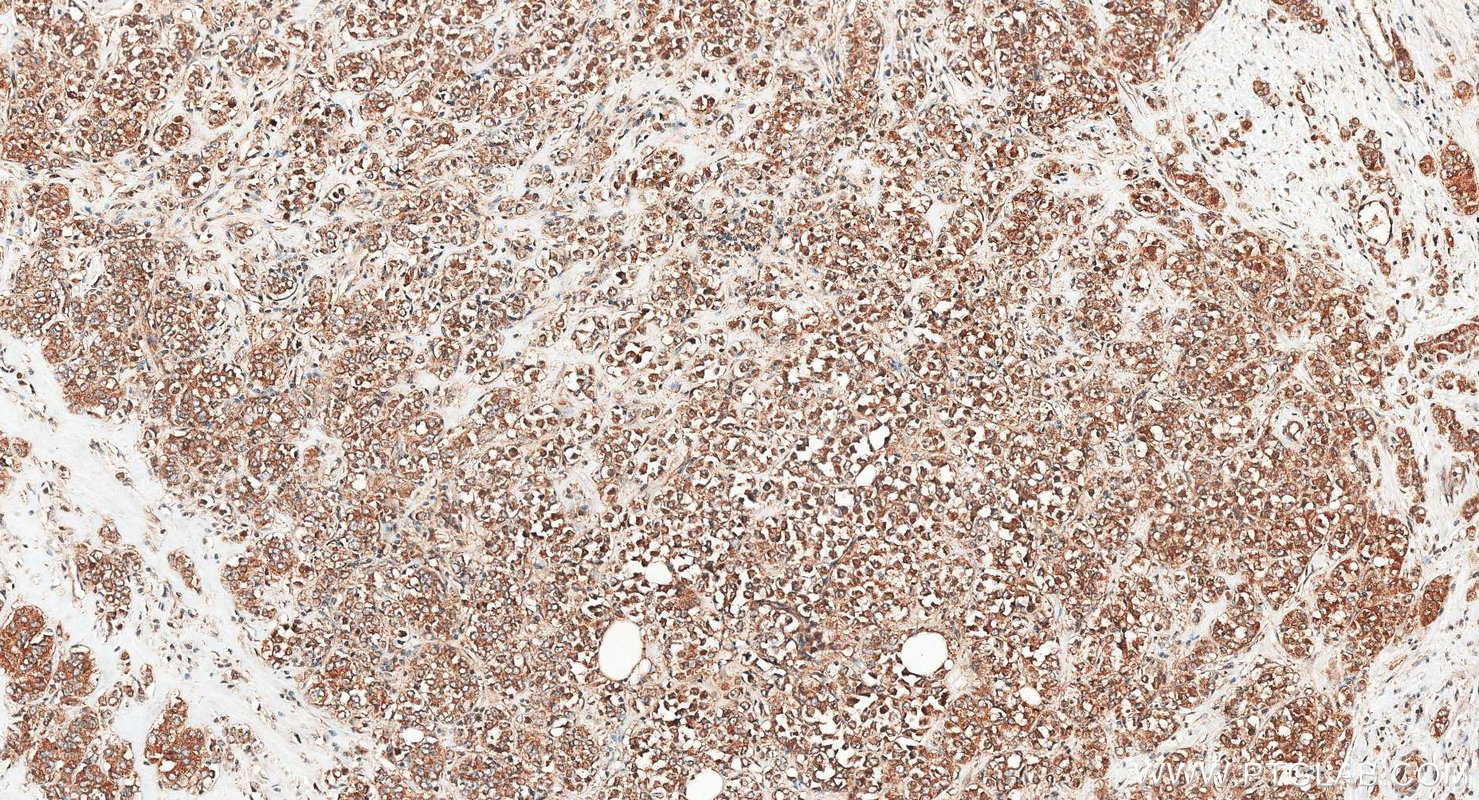 IHC staining of human breast cancer using 27921-1-AP