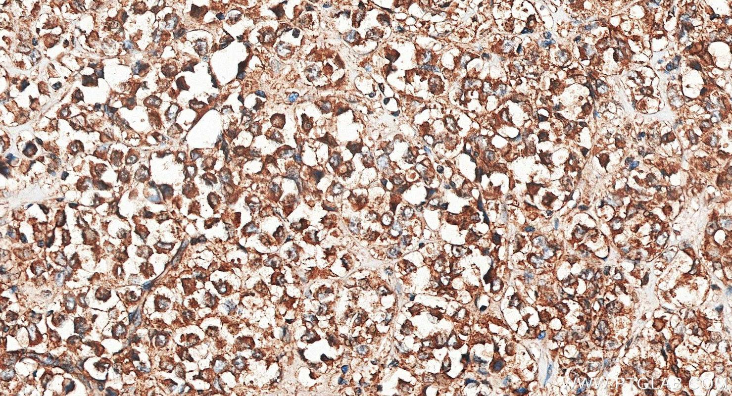 IHC staining of human breast cancer using 27921-1-AP