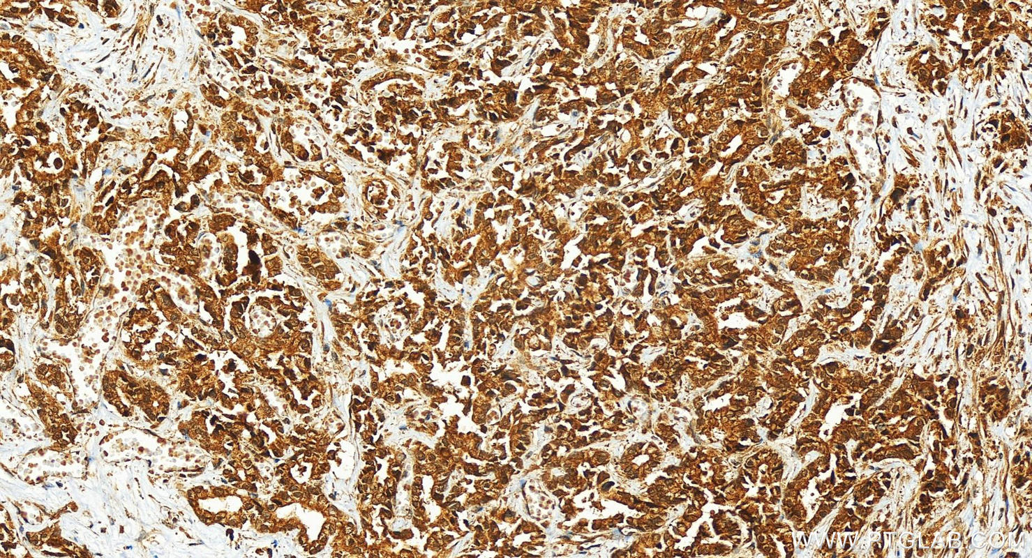 IHC staining of human intrahepatic cholangiocarcinoma using 14413-1-AP