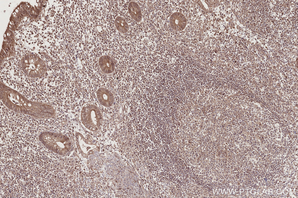 IHC staining of human appendicitis using 14413-1-AP
