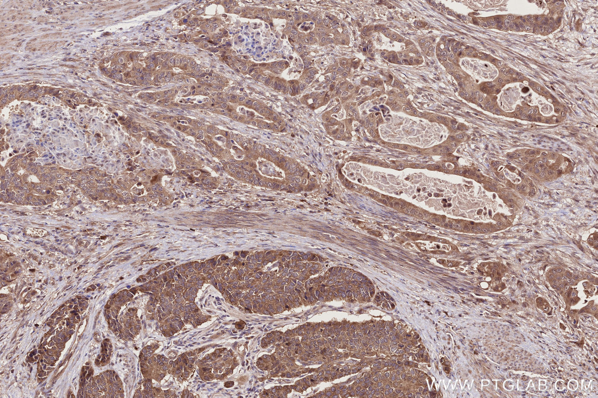 IHC staining of human stomach cancer using 14413-1-AP
