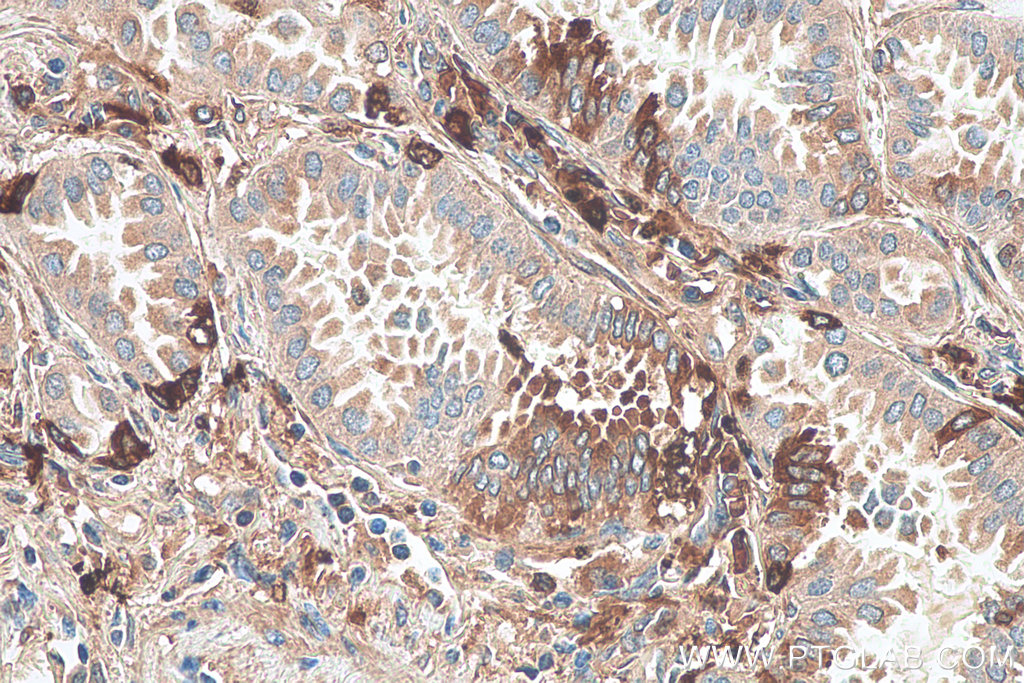 IHC staining of human lung cancer using 67564-1-Ig